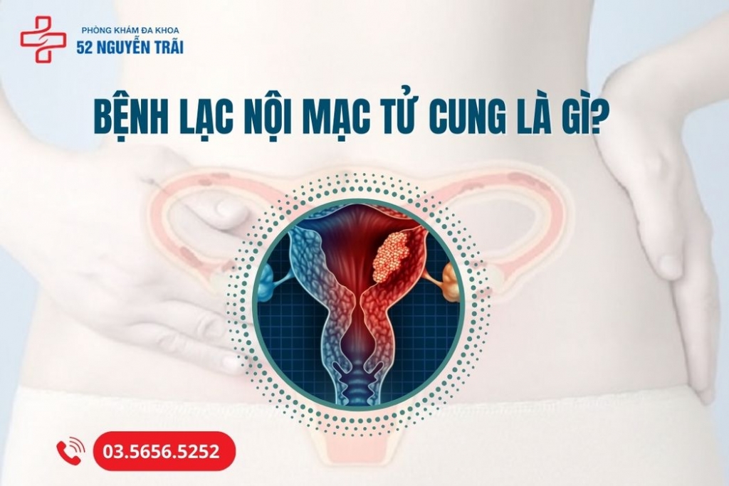 Bệnh lạc nội mạc tử cung là gì?