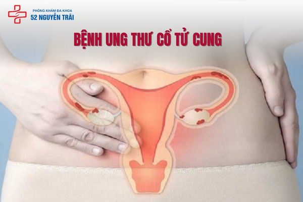 Bệnh ung thư cổ tử cung