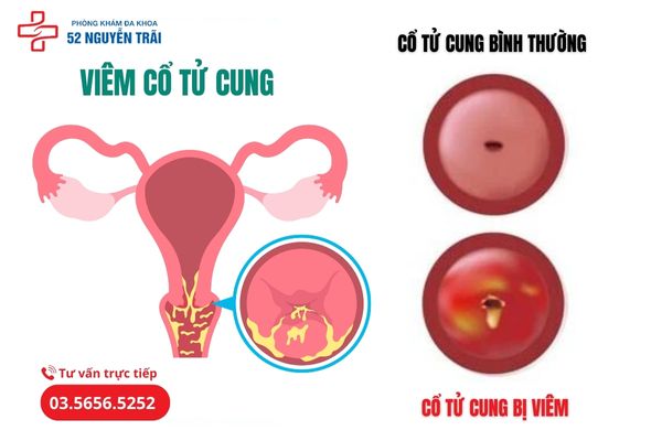 Bệnh viêm cổ tử cung