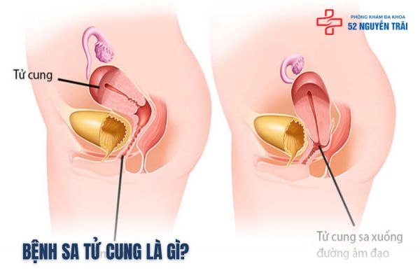 Bệnh sa tử cung là gì?