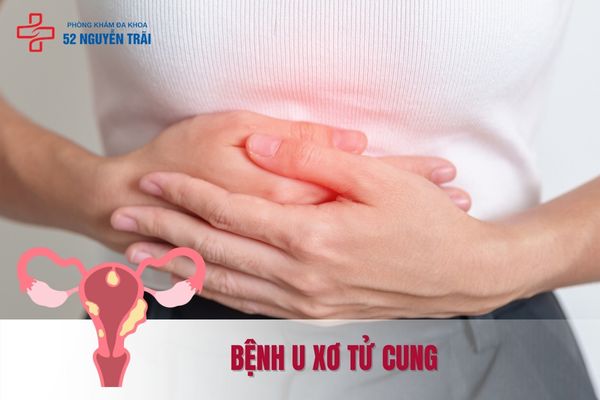 Bệnh u xơ tử cung