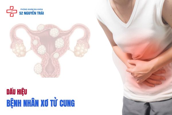 Dấu hiệu bệnh nhân xơ tử cung 