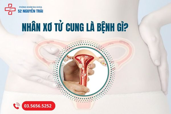 Nhân xơ tử cung là bệnh gì?