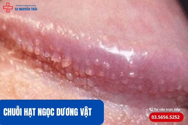 Chuỗi hạt ngọc dương vật 