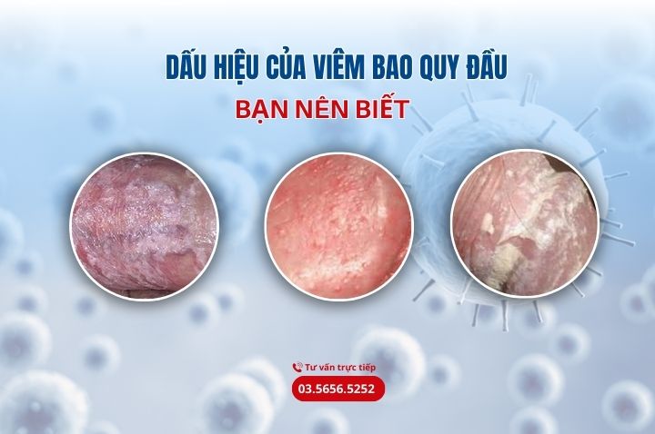 Dấu hiệu của viêm bao quy đầu