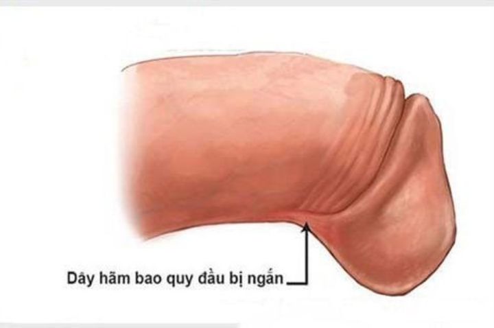 Dây hãm bao quy đầu ngắn là như thế nào?