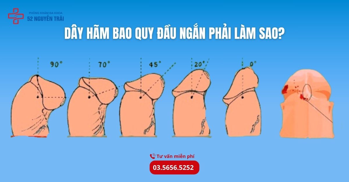 Dây hãm bao quy đầu ngắn