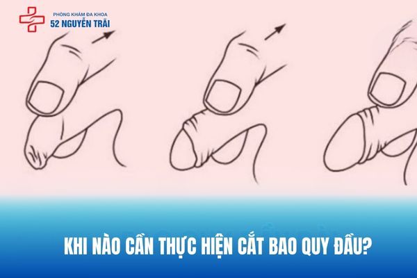 Khi nào cần thực hiện cắt bao quy đầu?