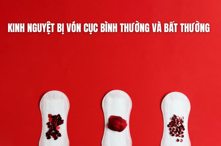 Kinh nguyệt bị vón cục bình thường và bất thường