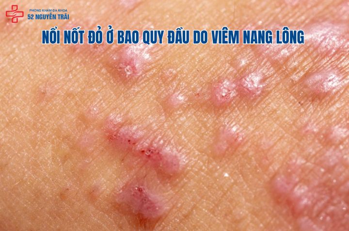 Nổi nốt đỏ ở bao quy đầu do viêm nang lông