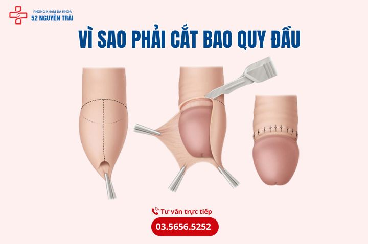 Vì sao phải cắt bao quy đầu